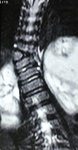 Pre-op MRI of the thoracic spine shows the T11 hemivertebra and acutely angled scoliosis deformity.